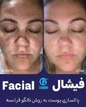 میکرونیدلینگ