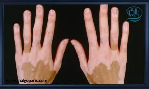 نشانه های ویتیلیگو