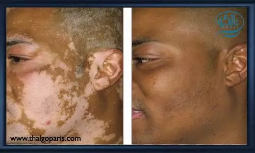 تاثیر بیماری پوستی ویتیلیگو بر اعتماد به نفس