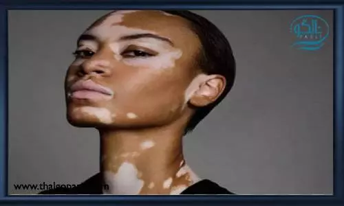 عوامل ایجاد بیماری ویتیلیگو