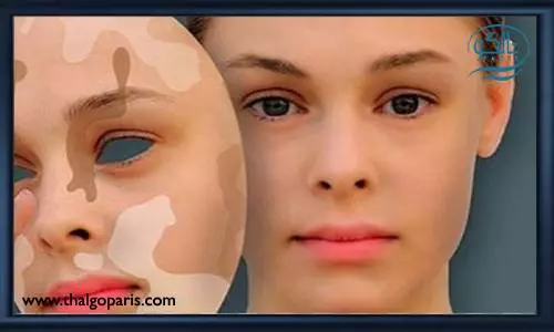 روش های درمان بیماری ویتیلیگو