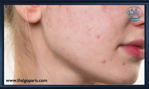 جلوگیری از جوش صورت هنگام استفاده از ماسک