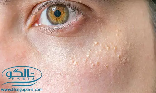 علل میلیا در نوزادان و بزرگسالان