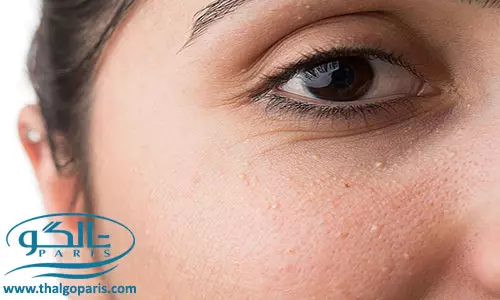 بیماری میلیا علل، علائم و درمان