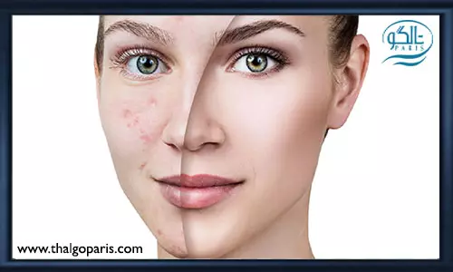 لایه برداری پوست به روش علمی