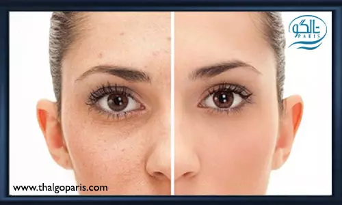 دلایل ایجاد لک بر روی صورت