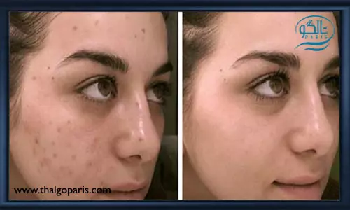 انواع روش از بین بردن لک های قهوه ای صورت