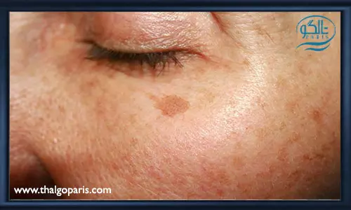 روش های مختلف از بین لک صورت