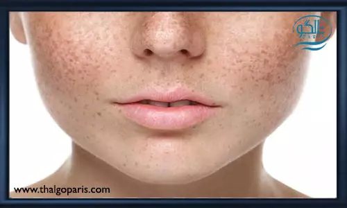 آشنایی با روش های مختلف از بین بردن لک صورت