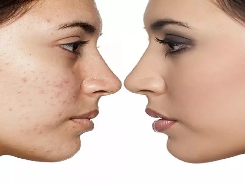 نکات مهم برای ایمنی و مراقبت بعد از فشیال جوش زیرپوستی