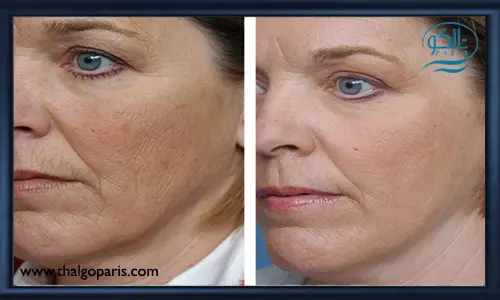 لایه برداری پوست با لیزر و مزایای آن