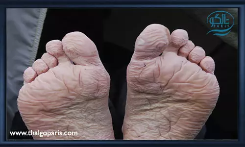 دلایل ترک پا در فصل سرما