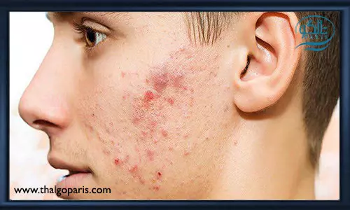 پوست های مستعد آکنه و استفاده از کرم های ضد آفتاب