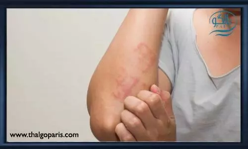 عوارض بیماری کووید 19 بر روی پوست