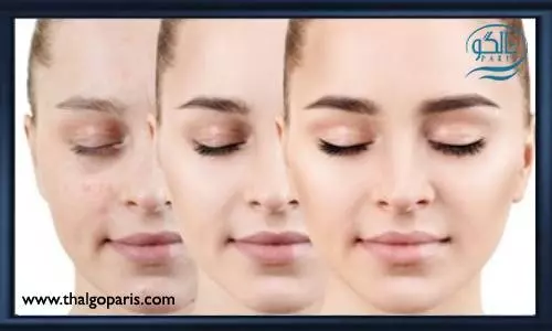 از بین بردن جوش پوستی با شستشوی صحیح