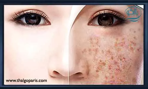 کرم ضد لک چیست