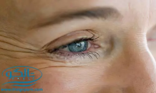 درمان و رفع چین و چروک دور و زیر چشم