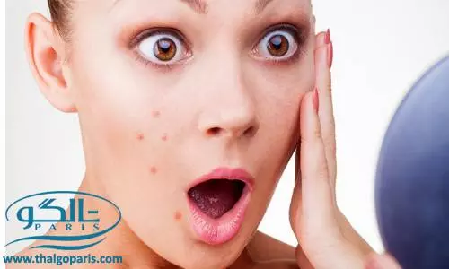 عوامل به وجود آمدن جوش صورت و روش های پیشگیری 