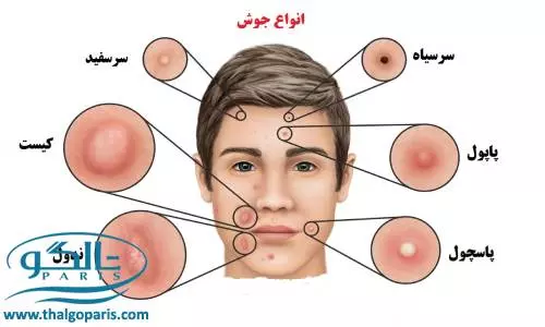 عوامل به وجود آمدن جوش صورت و روش های پیشگیری 