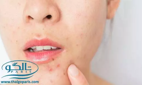 علت جوش صورت چیست؟