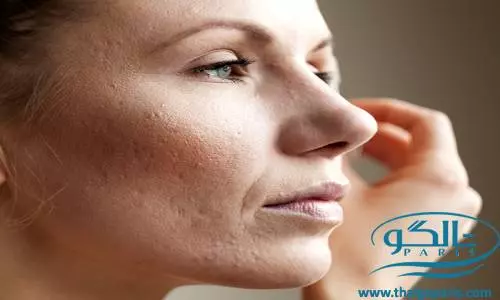 معرفی بهترین راه‌های درمان منافذ باز پوست