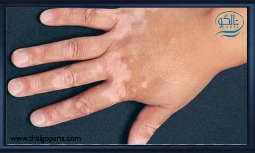 بیماری پوستی ویتیلیگو و راه های درمان