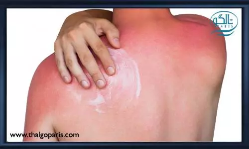 آفتاب سوختگی و برنزه شدن