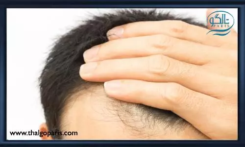 ریزش مو بر اثر استعمال دخانیات