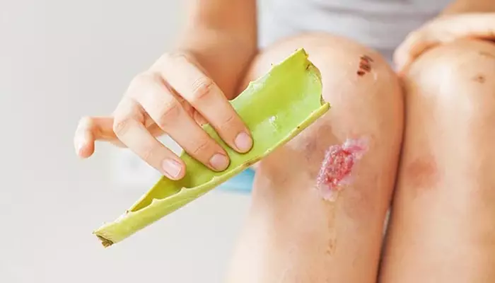 آلوورا برای زخم