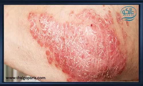 انواع اگزمای پوستی