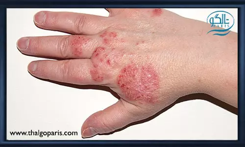 علائم اگزمای پوستی