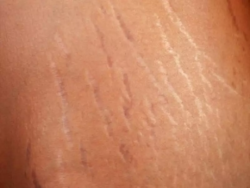اصول میکرونیدلینگ برای ترکهای پوستی