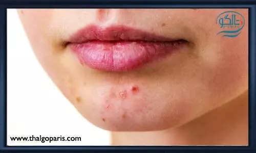 انواع دلایل به وجود آمدن جوش در صورت