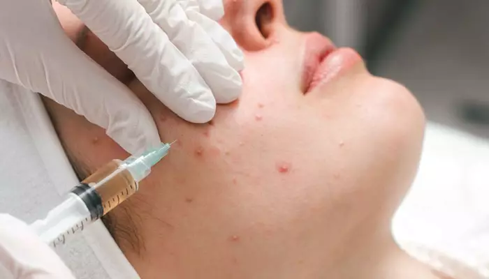 تزریق کورتیزون برای درمان جوش زیرپوستی